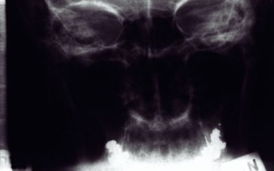 maladie de Crohn diagnostic : comment identifier et confirmer la maladie ?